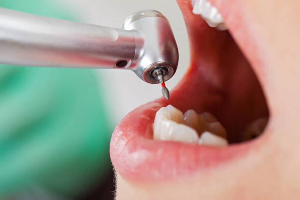 Best Emergency Treatment for Dental Infections or Abscesses in Quincy, FL